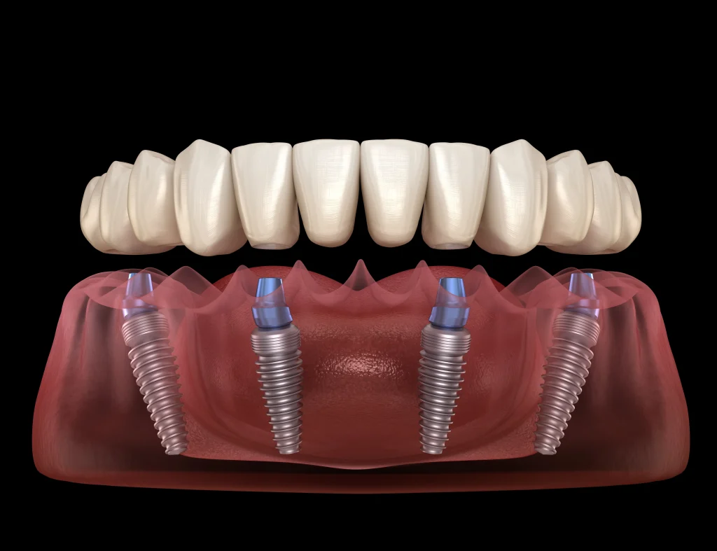 All-on-4 dental implants illustration showing fixed full arch teeth supported by four implants in Yuba City.