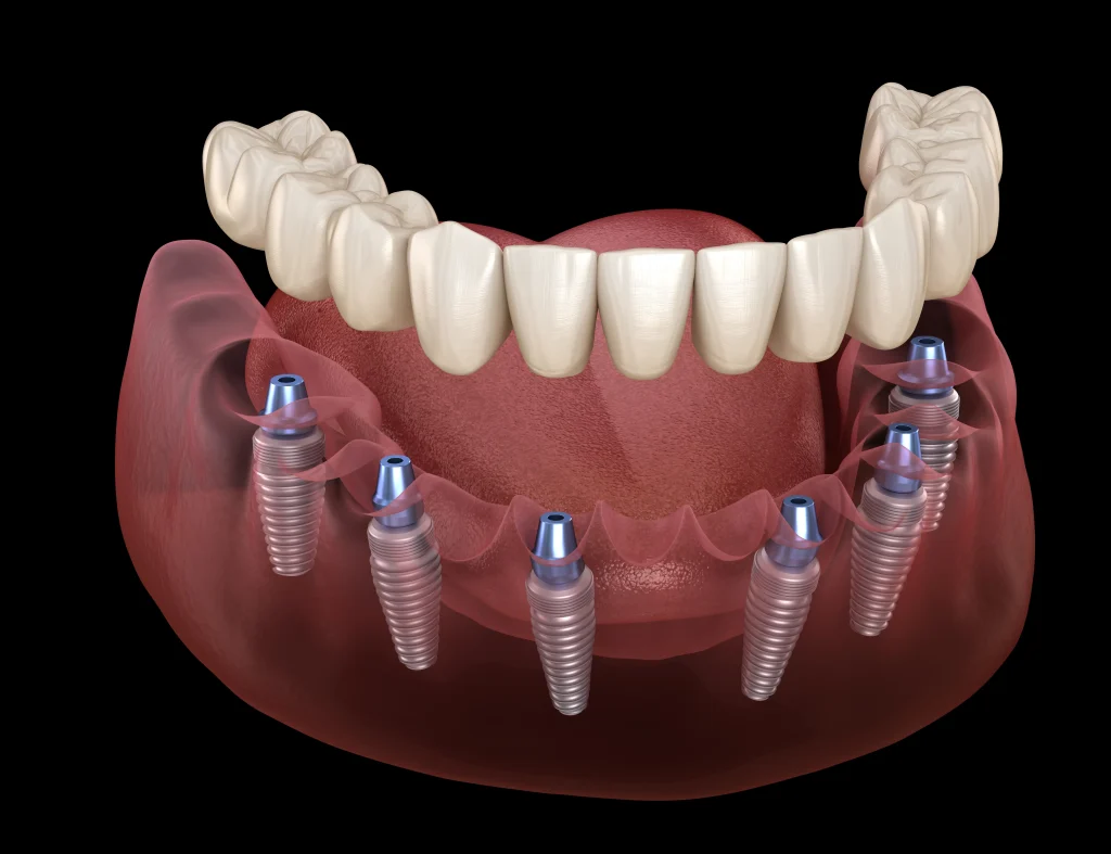 All-on-X full arch dental implant system with four angled implants supporting a permanent bridge in Yuba City.