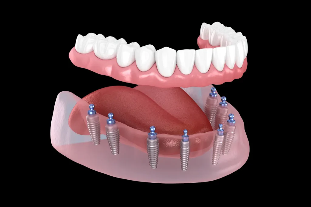 Snap-in implant-supported dentures with multiple implants and locator attachments for improved denture stability in Yuba City.