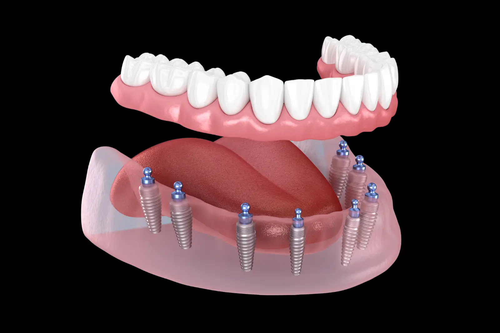 Snap-in implant-supported dentures with multiple implants and locator attachments for improved denture stability in Yuba City.