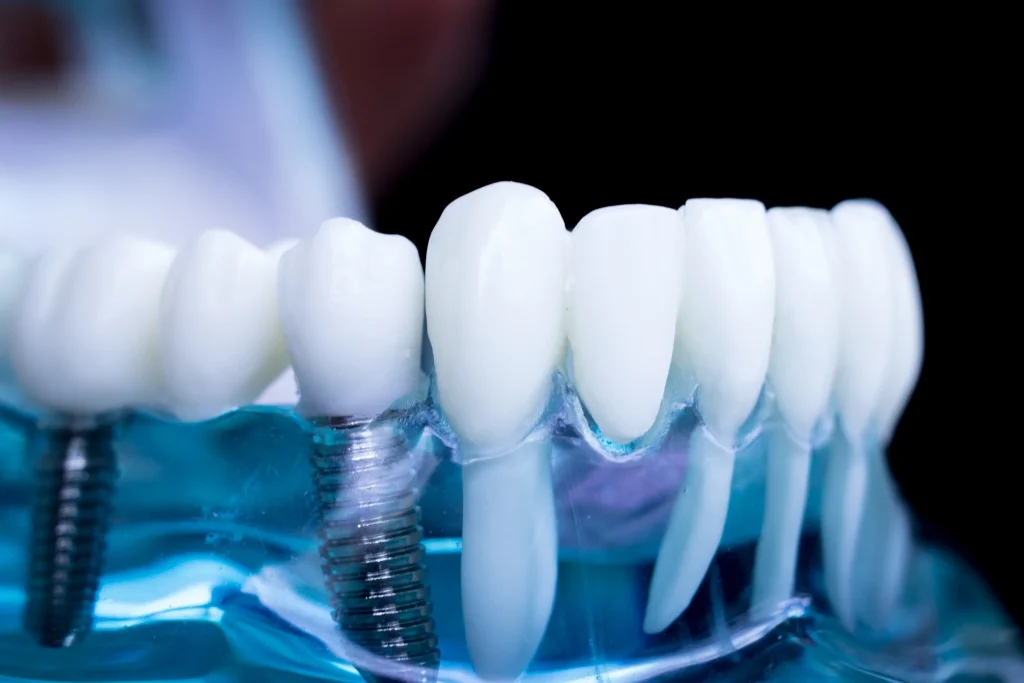 Close-up dental implant model showing titanium implant and natural-looking crown