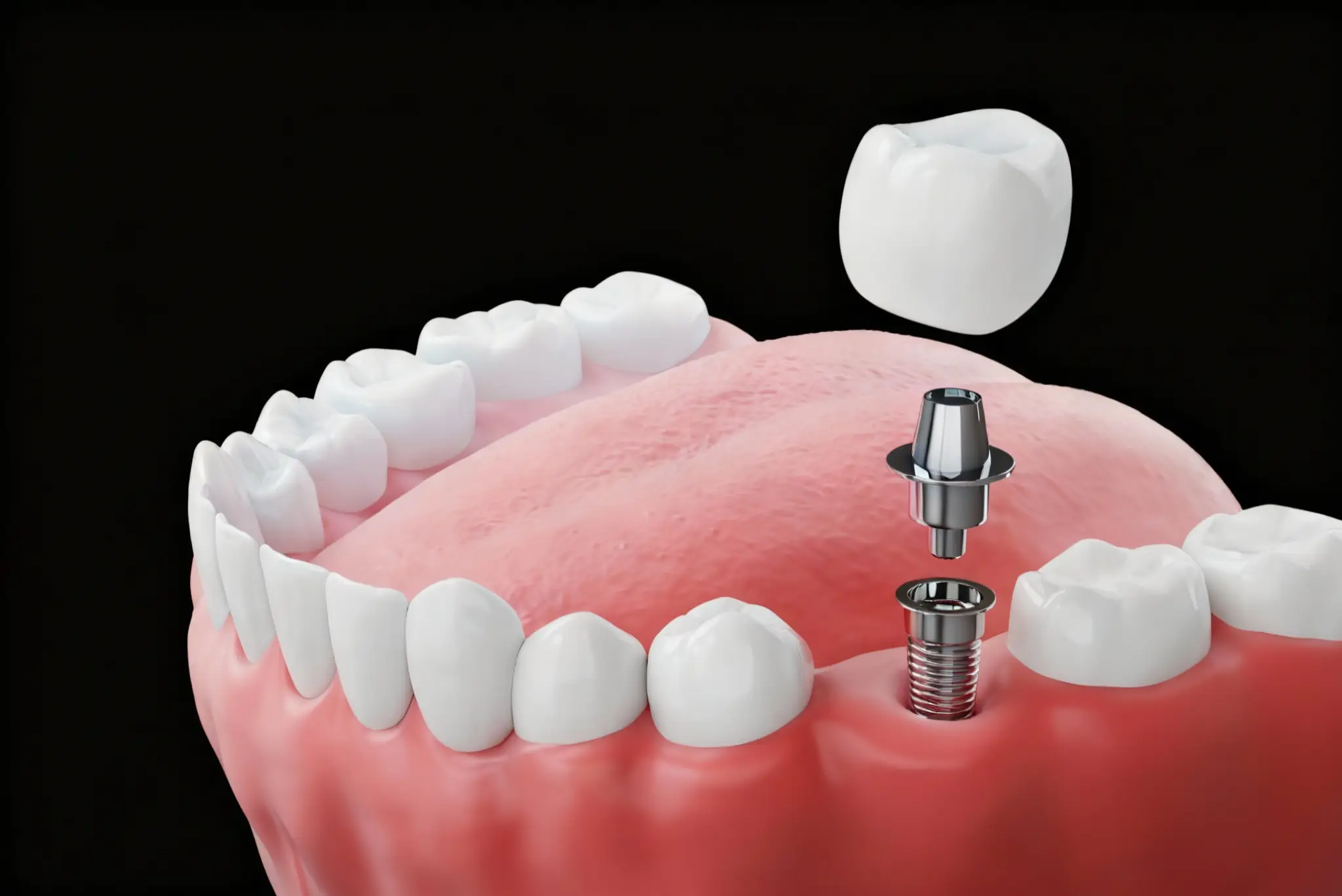 Single tooth dental implant placement showing implant, abutment, and crown replacement in Yuba City.