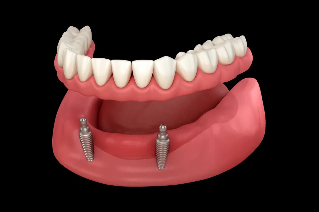 Teeth in a Day full arch dental implant illustration showing fixed upper teeth and two lower implants with natural pink gums at Yuba City Implant Center.