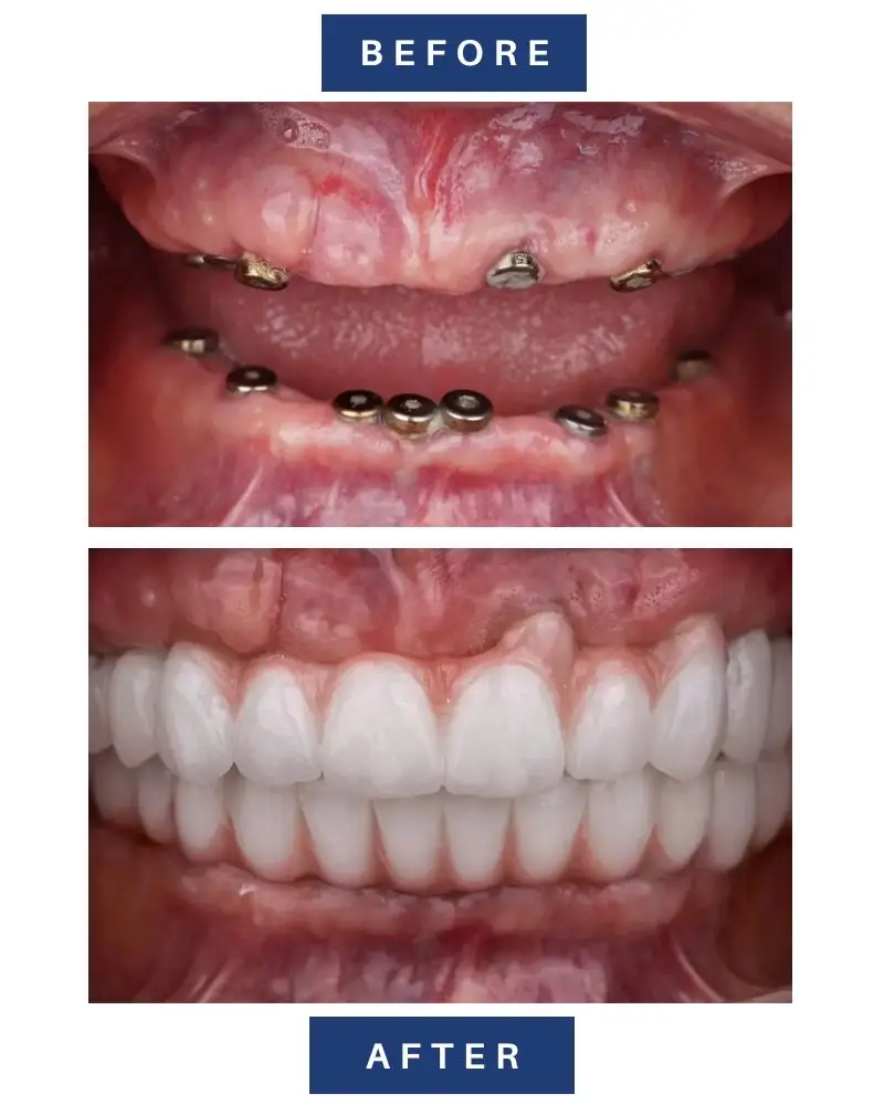 Comparison of dental implant healing abutments and the final full-arch zirconia bridge result.