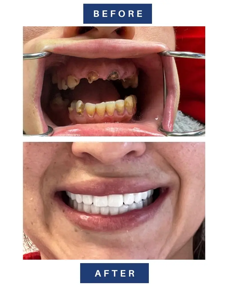 Before and after of an extreme smile makeover for a Yuba City patient with severely damaged teeth restored with full mouth implants.