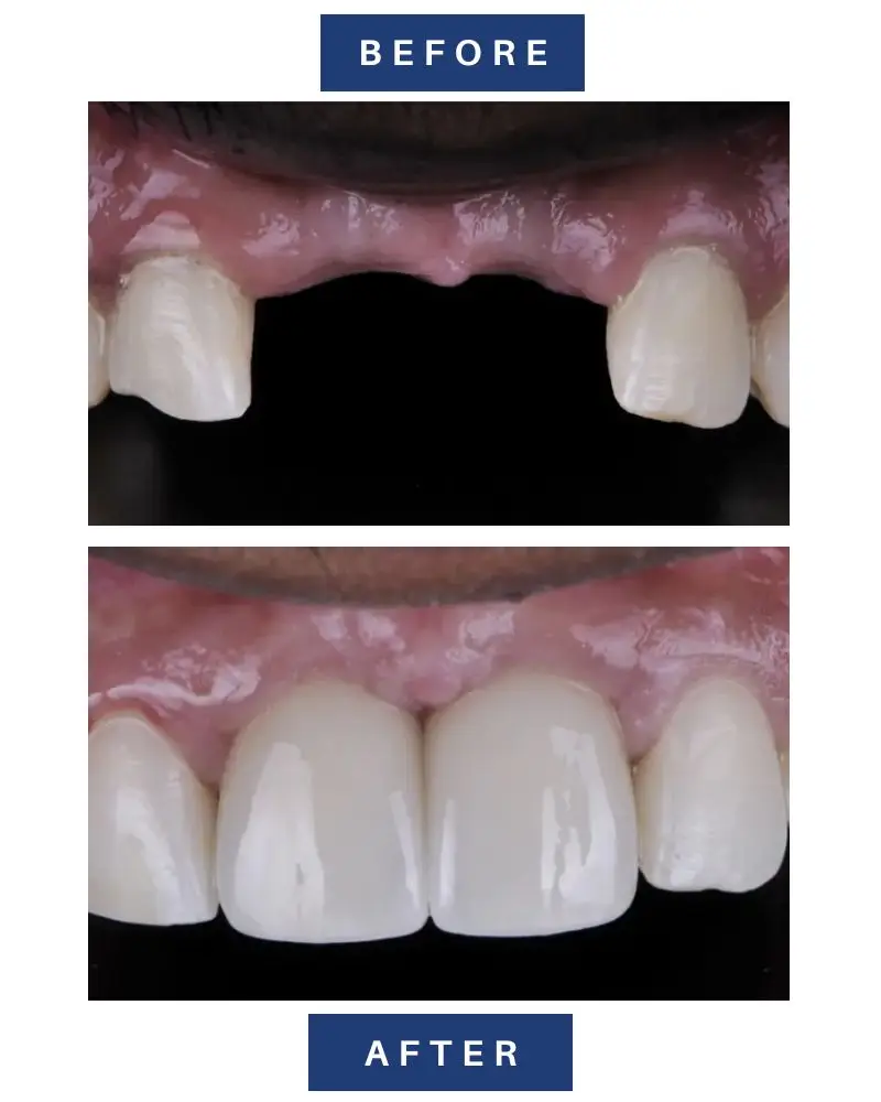 Before and after comparison of a front tooth gap restoration using a custom dental implant bridge at Yuba City Implant Center.
